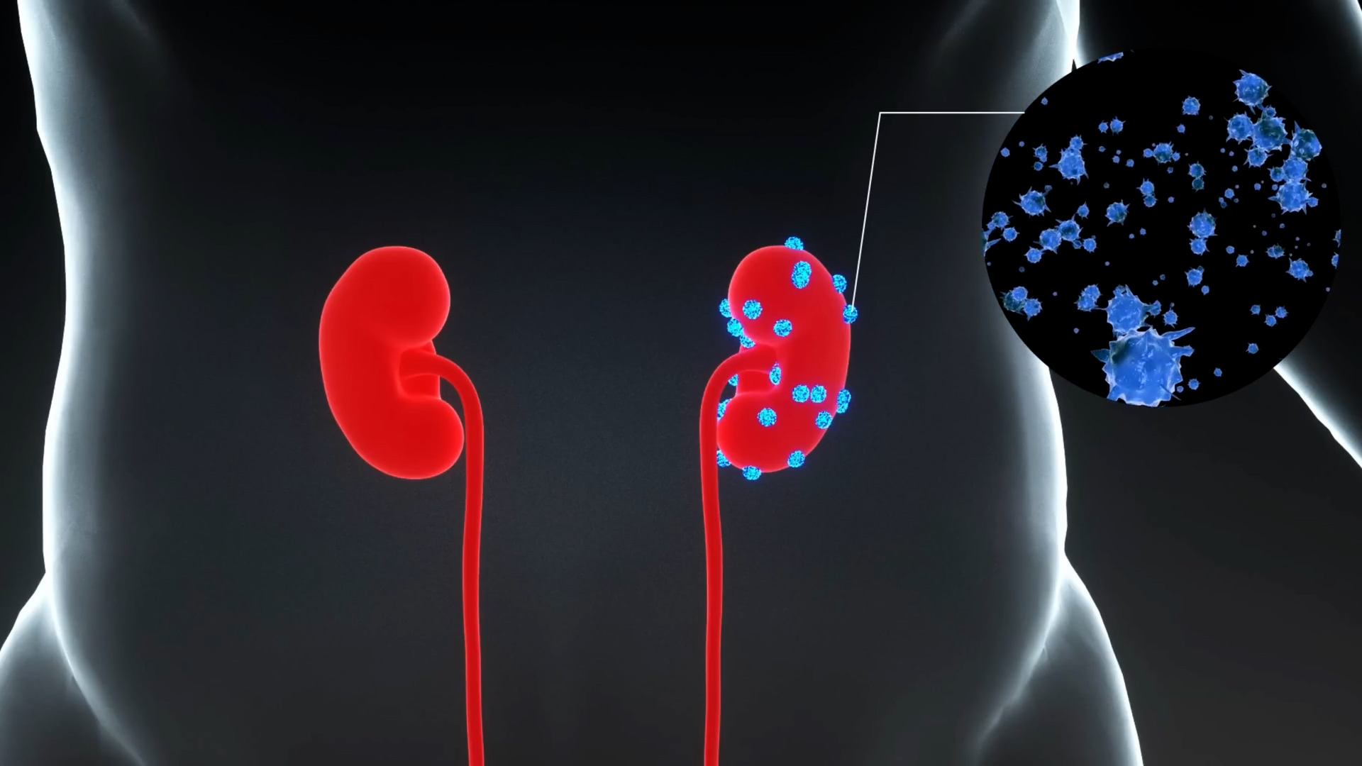 The newer medications helping slow kidney disease, explained by a ...