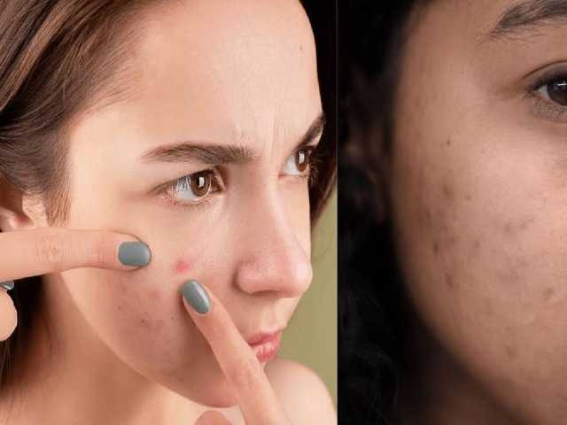 Stubborn chickenpox scars on your face, safe recovery tips, what to avoid