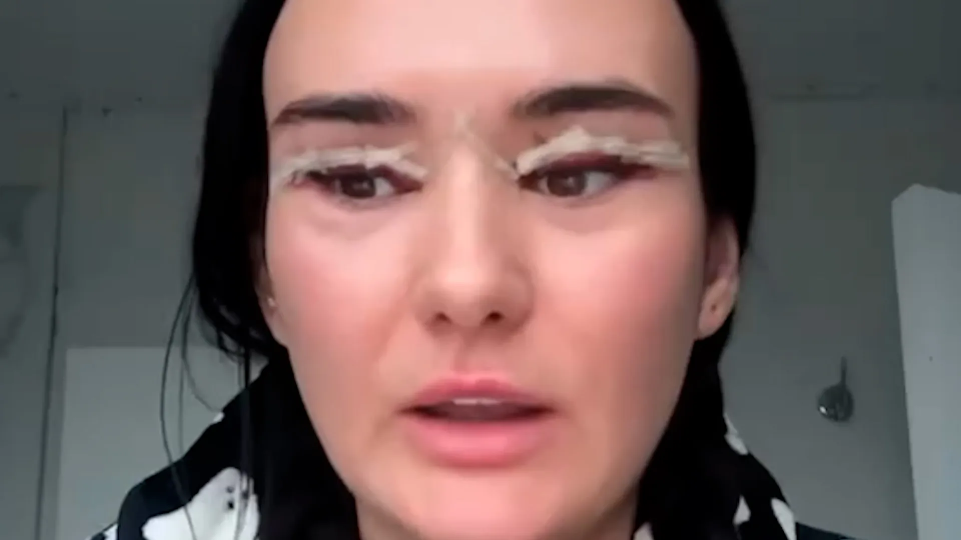Woman warns against trusting TikTok after £635 eyelid surgery leaves ...