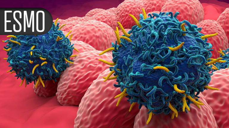 Novel ADC achieves impressive PFS advantage in HER2-low metastatic ...