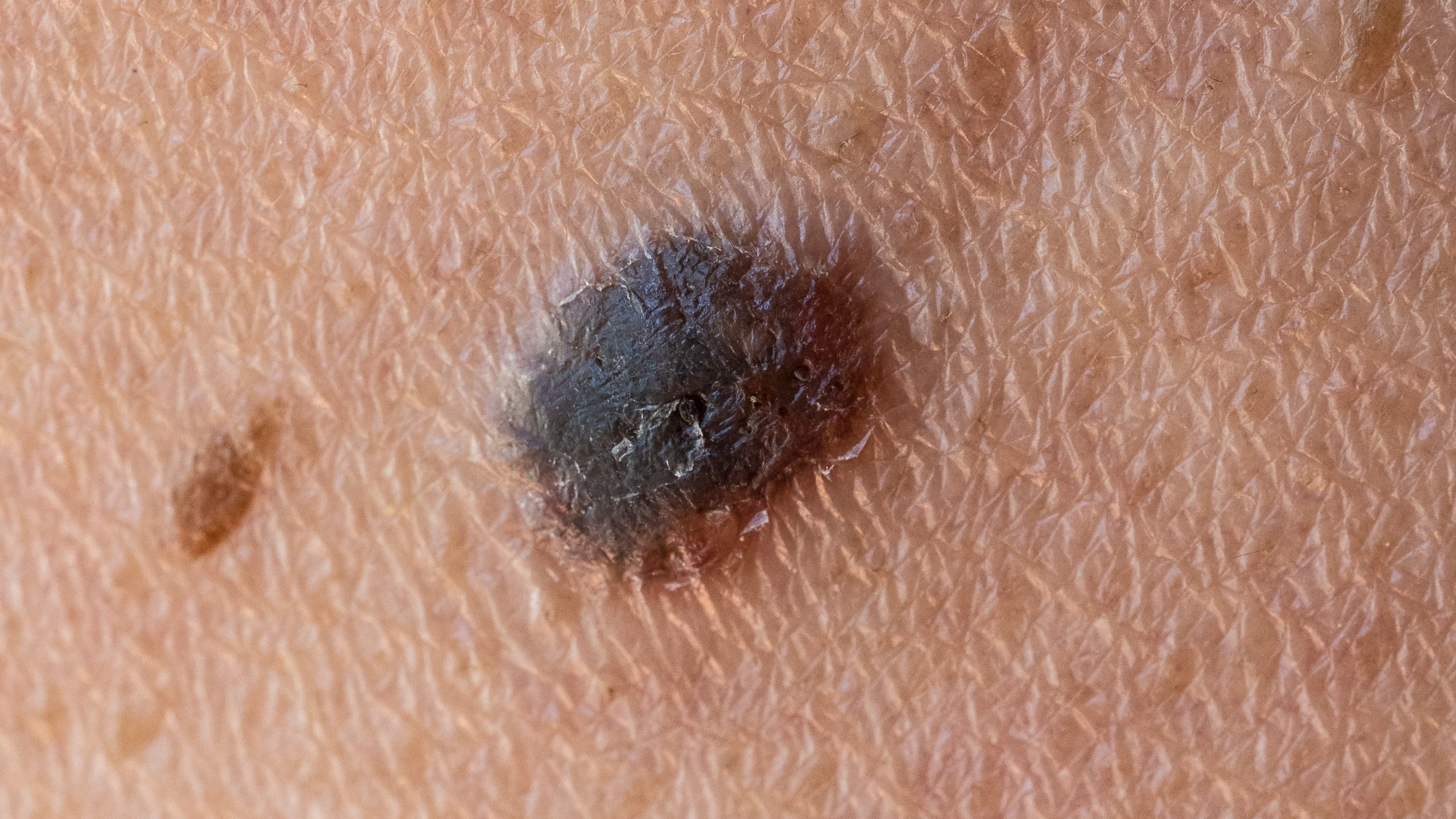 World-first cancer vaccine cuts melanoma recurrence or death risk by 42% in landmark trial