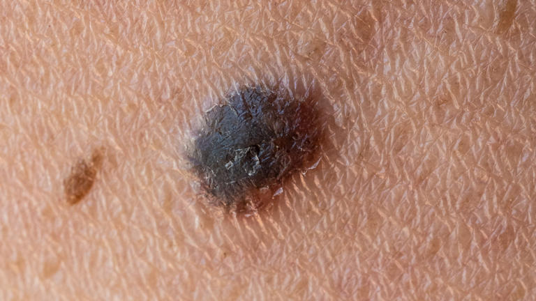 World-first cancer vaccine cuts melanoma recurrence or death risk by 42 ...