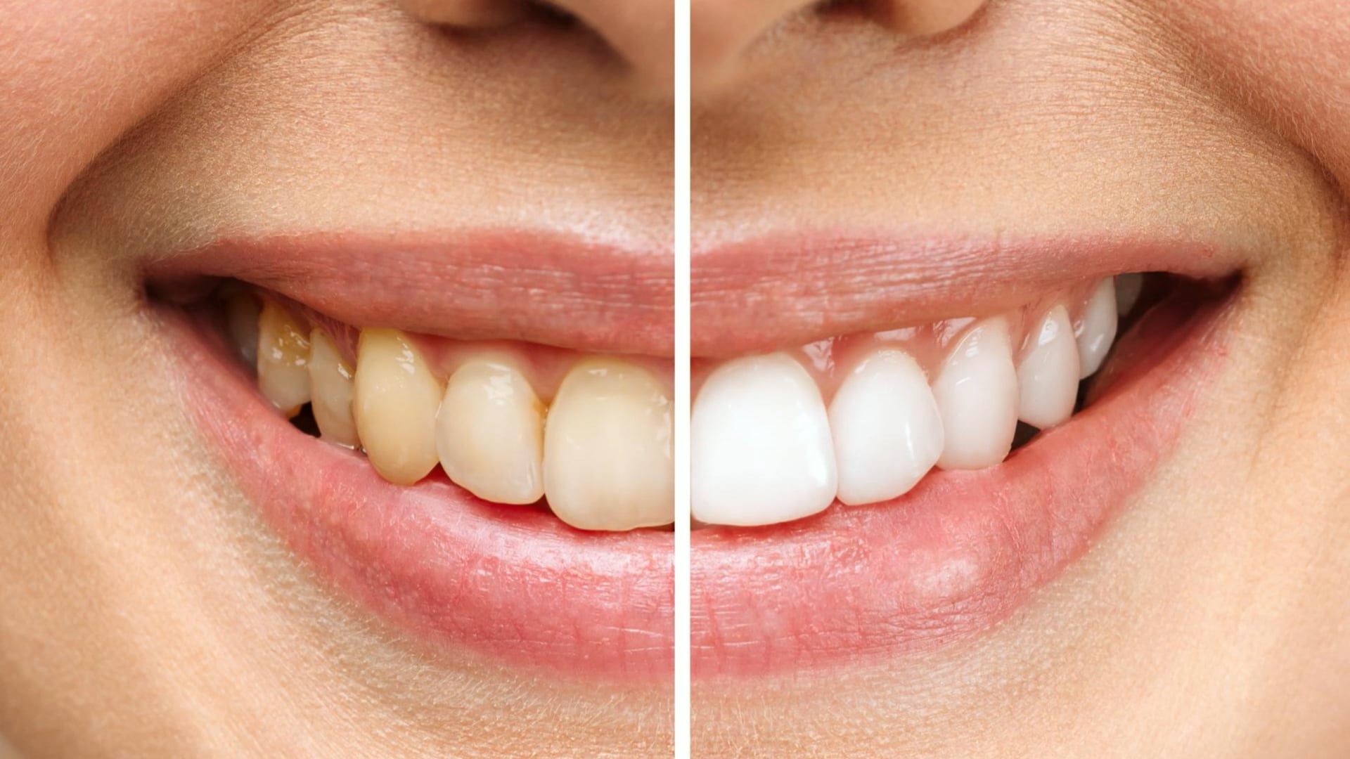 Is whitening toothpaste truly safe for your enamel?