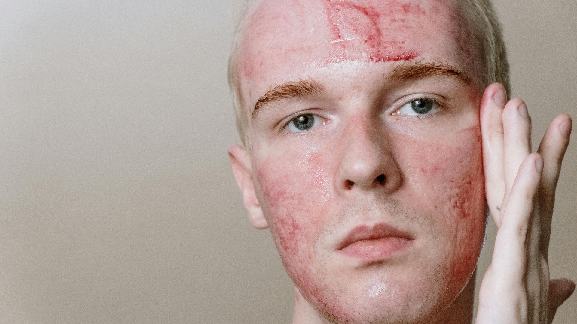 20 things to never say to someone with acne
