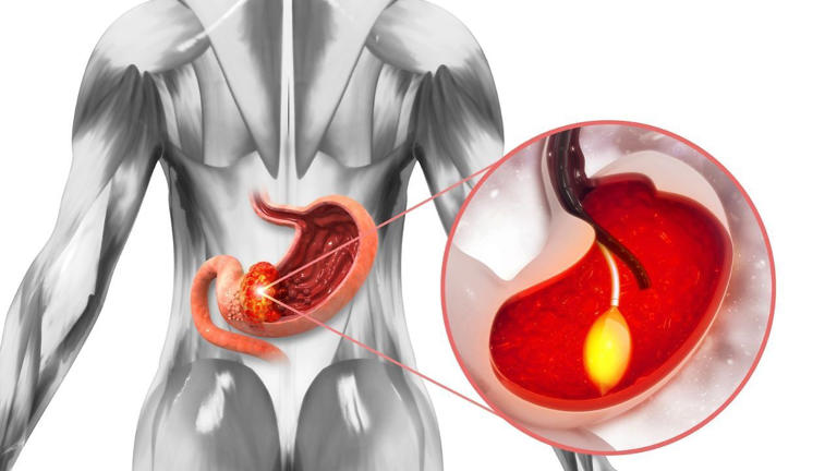AstraZeneca’s experimental stomach cancer drug doubles survival in late ...