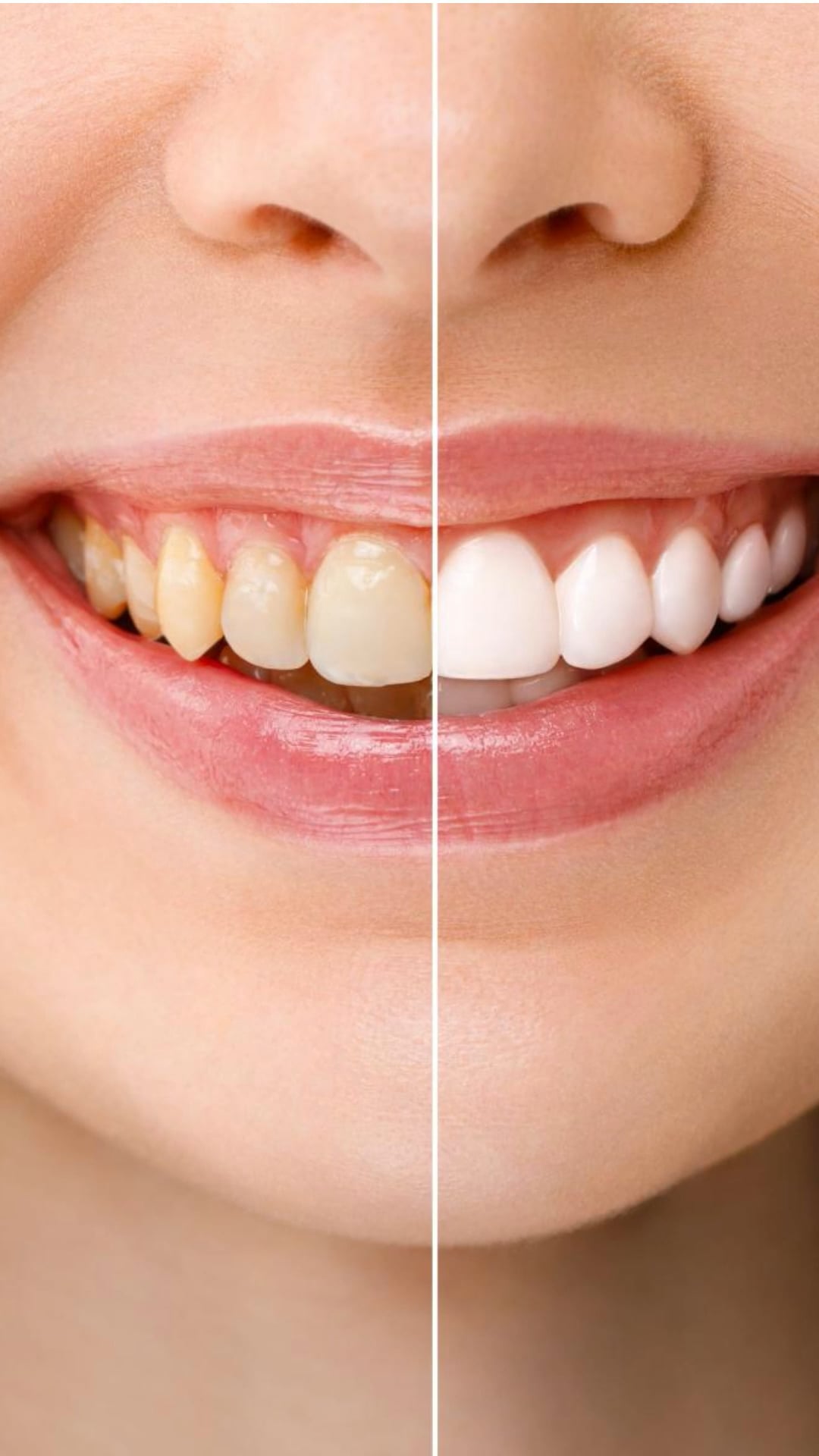 Is whitening toothpaste ruining your natural teeth?