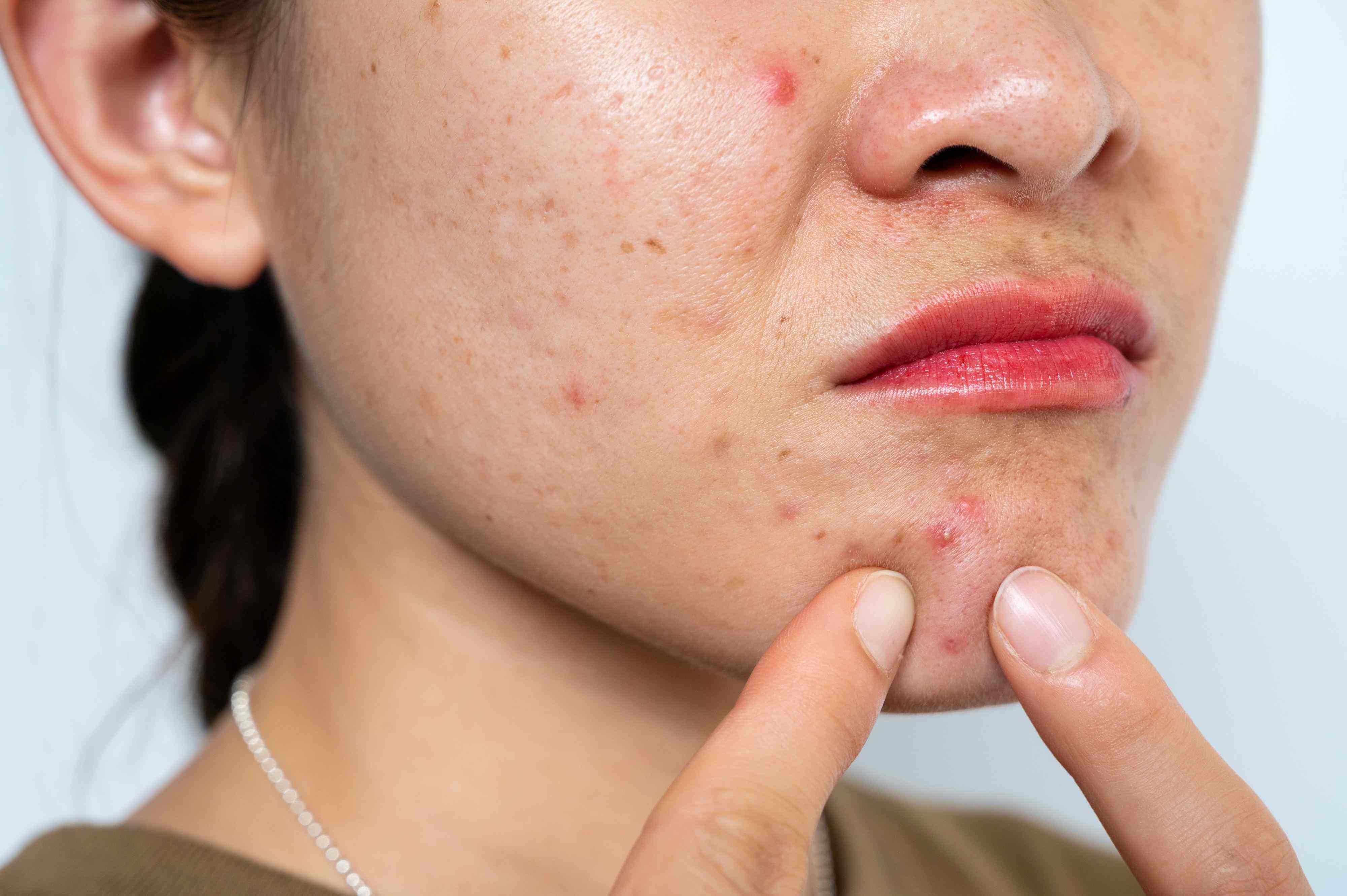 4 reasons why experts tell you to never pop a pimple