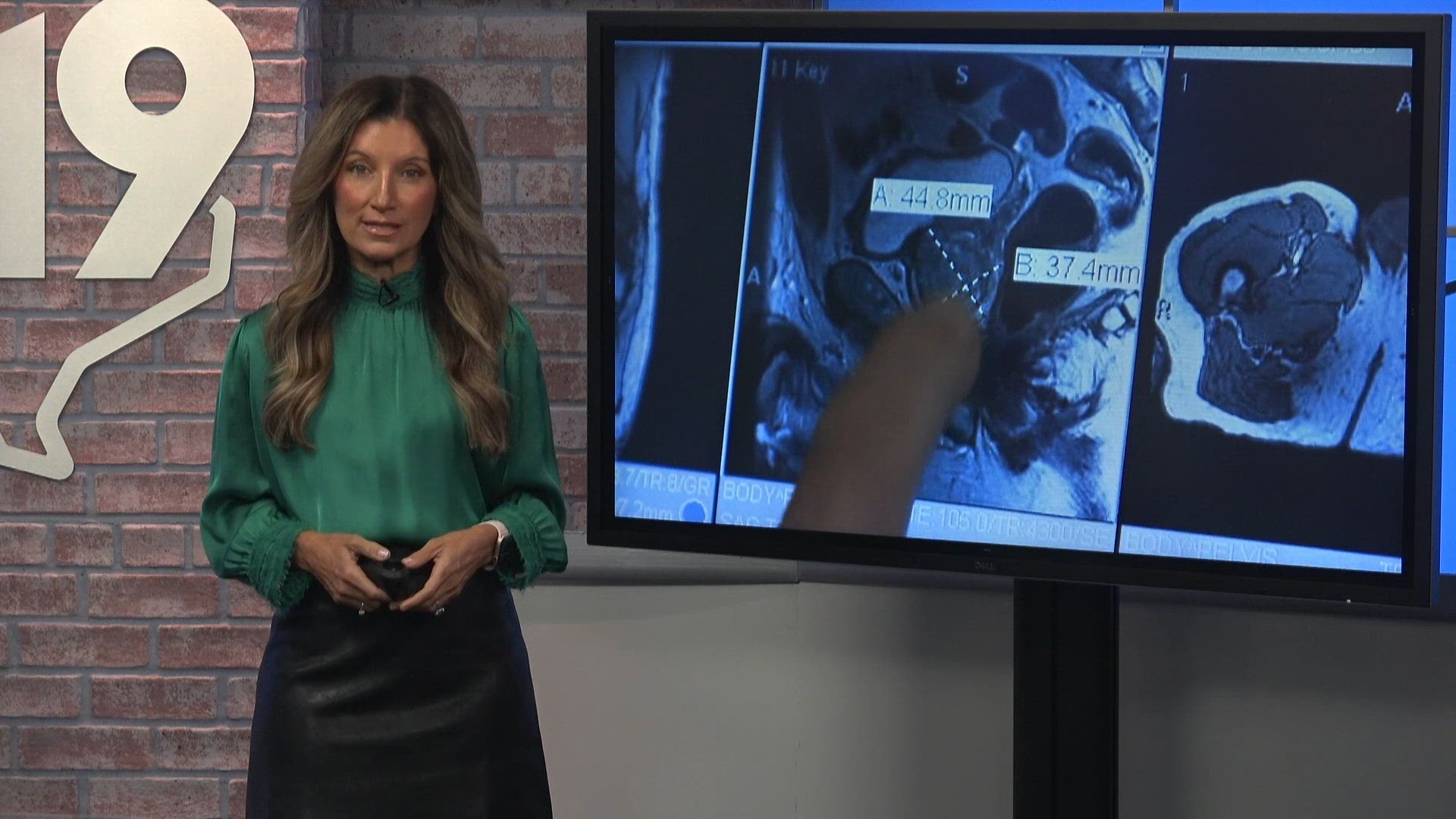 Study finds shift away from radiation for low-risk prostate cancer