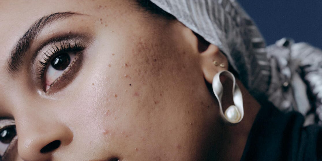 The best skincare routine for acne is way simpler than you think