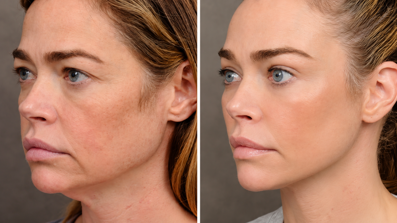 Plastic surgeon compares Kris Jenner and Denise Richards’ facelifts