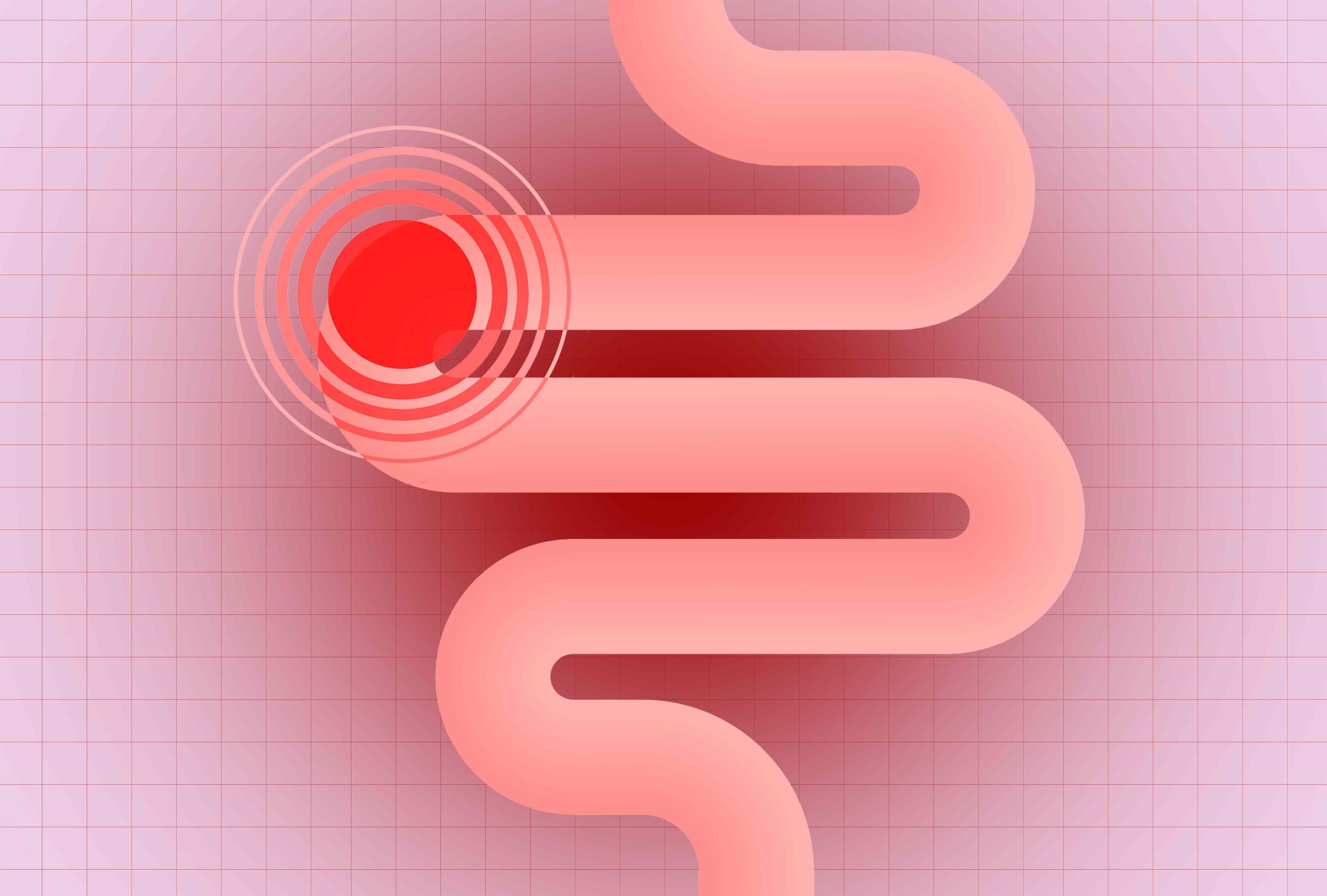 Scientists just connected 2 types of ultra-processed foods to lower colon cancer risk