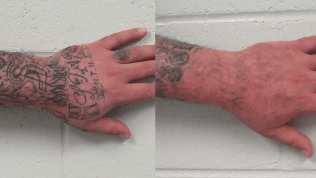 Local program helps people in jail remove tattoos and start fresh
