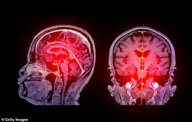 Gene switch therapy could prevent and treat Alzheimer's