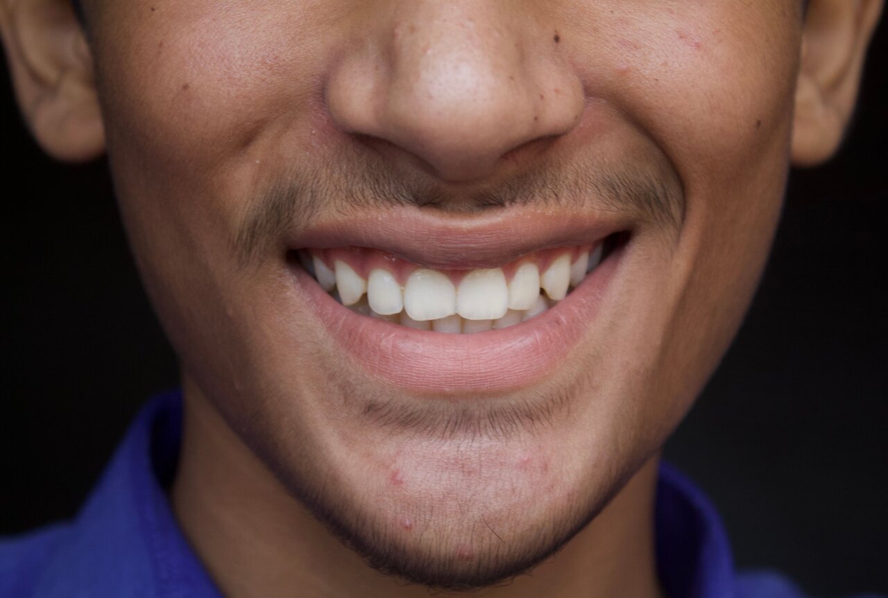 Rare gene variants linked to dental differences that shape our smiles