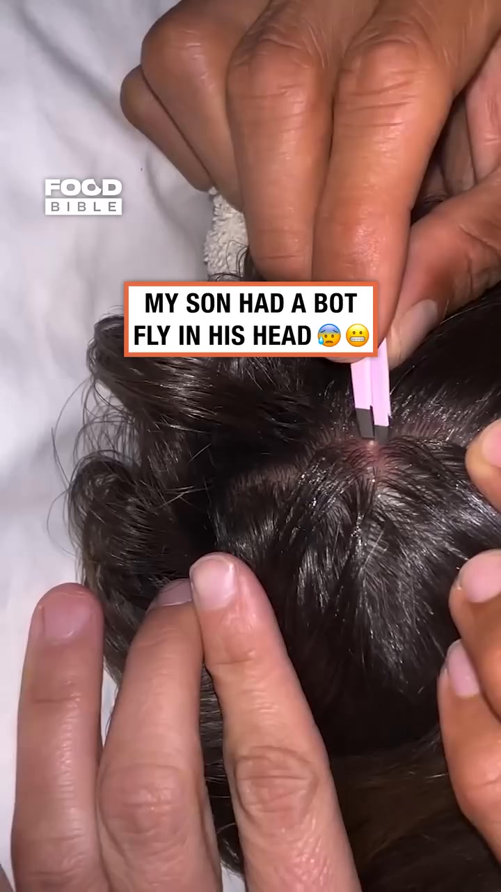 My son had a bot fly in his head 😳