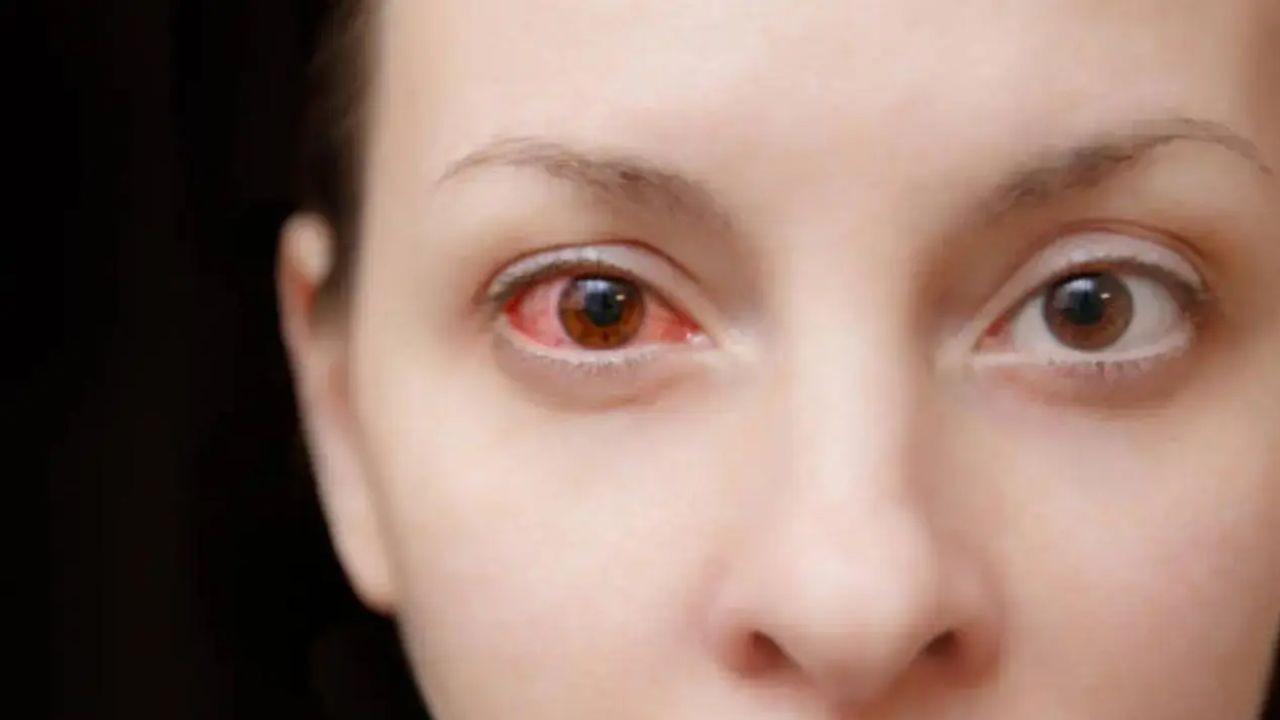 Conjunctivitis cases rise in Pune amid weather transition, festive crowds