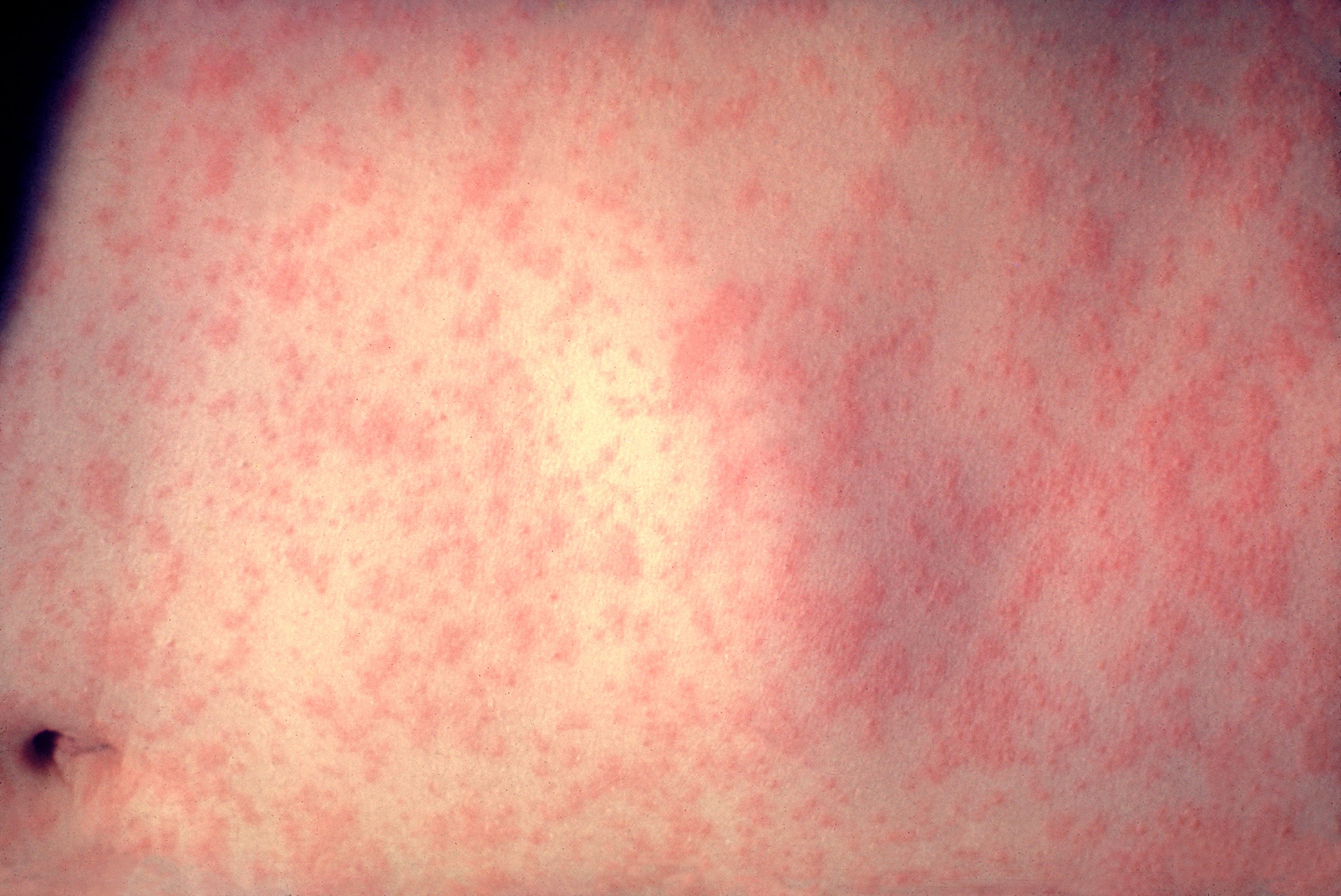 Three additional measles cases confirmed in Georgia