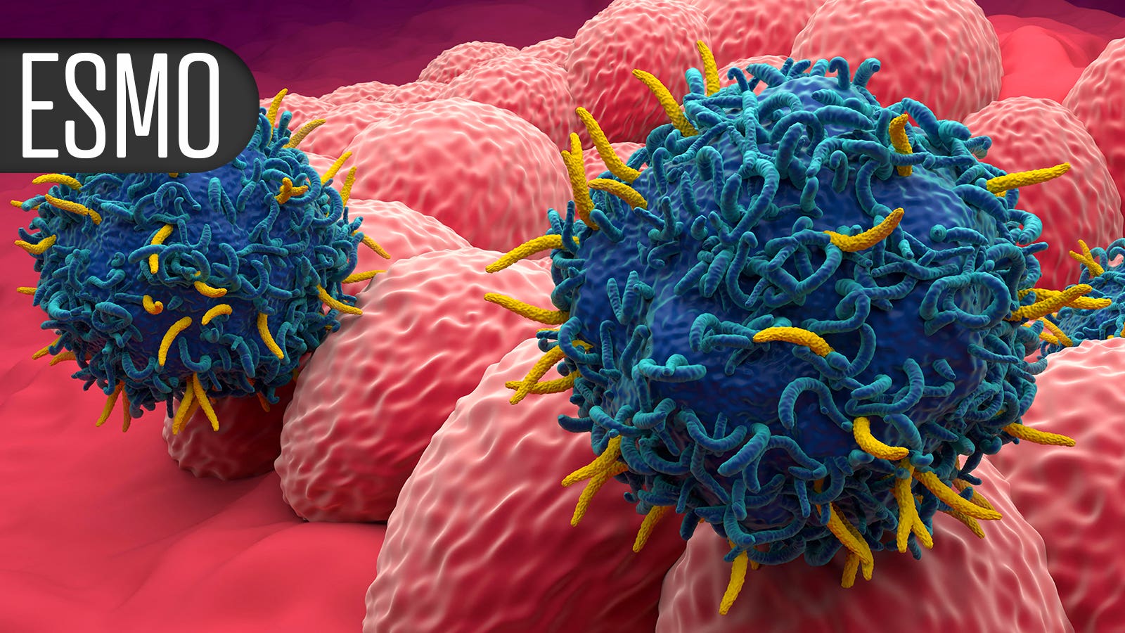 Trial results show 'something we have not seen for years' in osteosarcoma