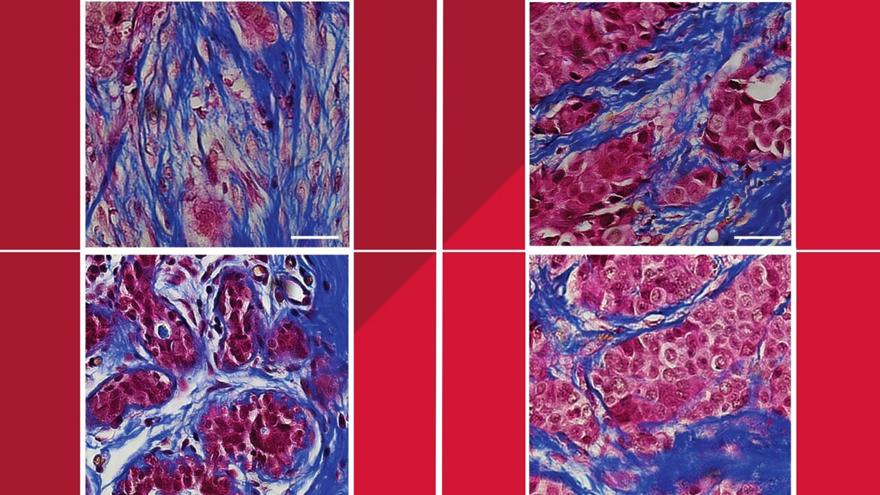 How socioeconomic factors affect outcomes in this deadly cancer