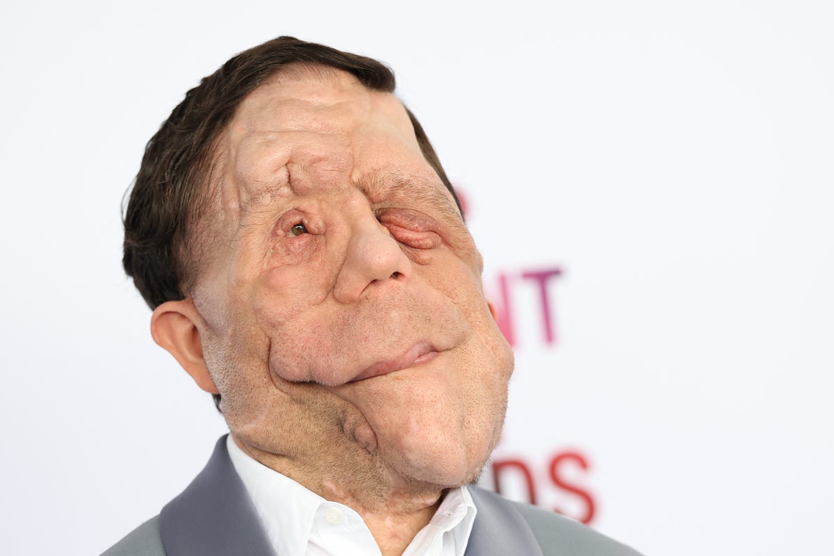 Adam Pearson reveals was hit by car on way to Under the Skin audition