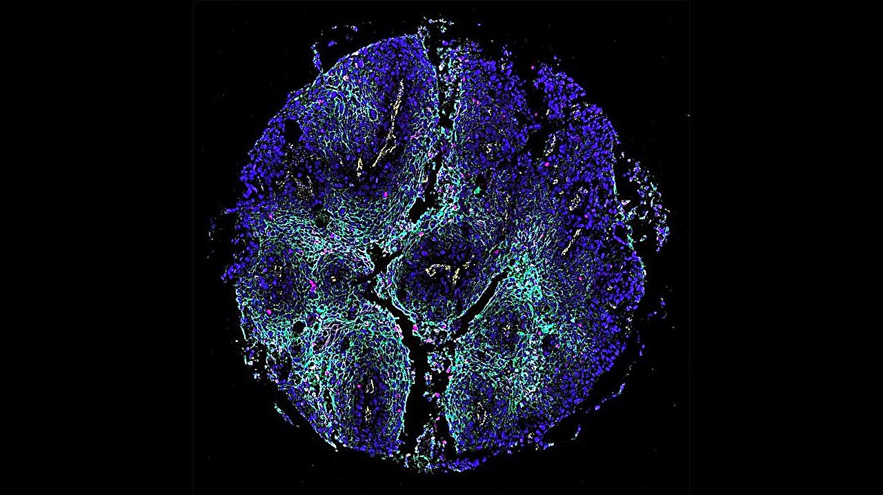 New tissue atlas aims to help AI understand cancer