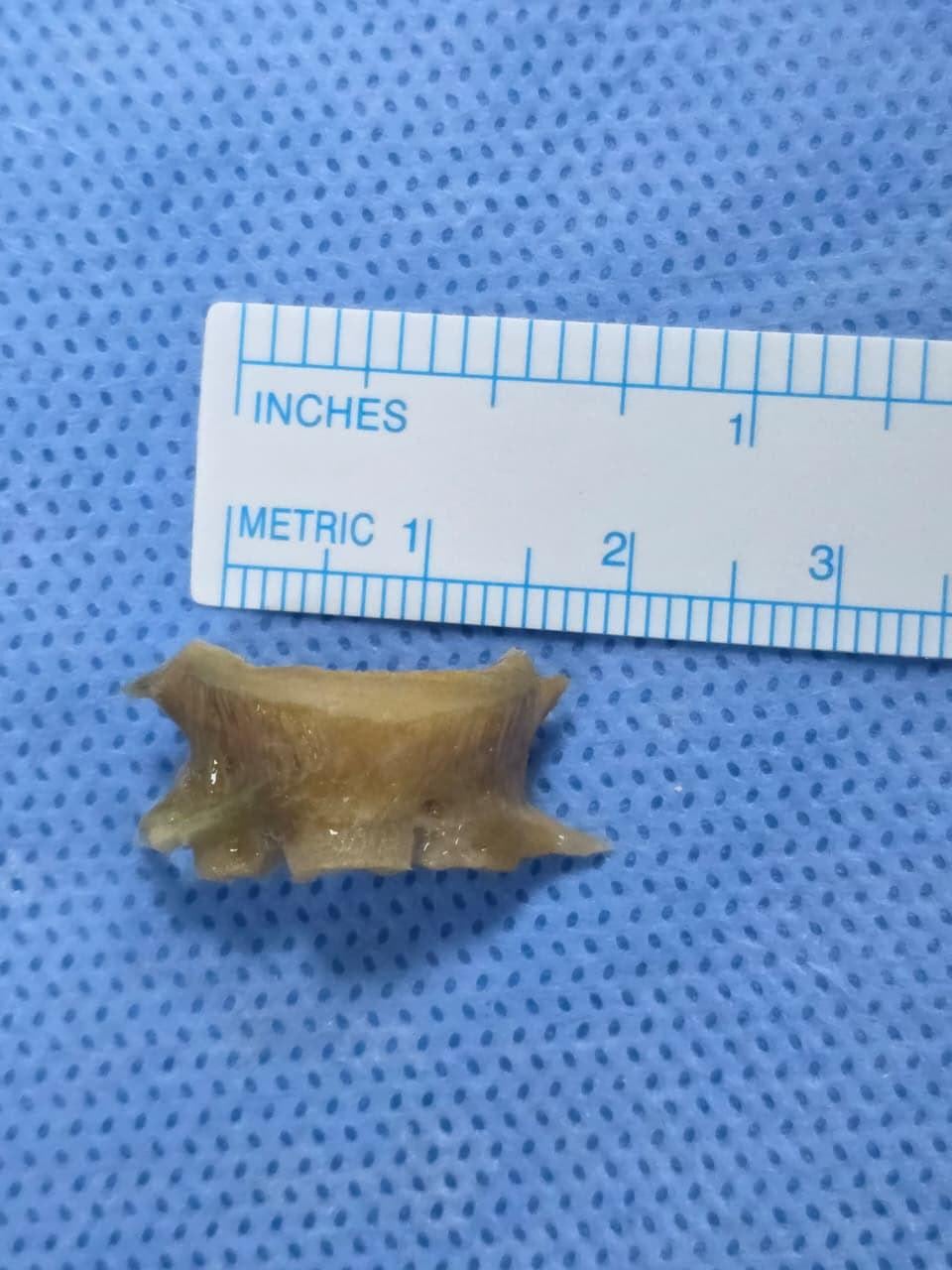 Dubai doctors remove 2cm fish bone lodged in Sharjah man's airway for ...