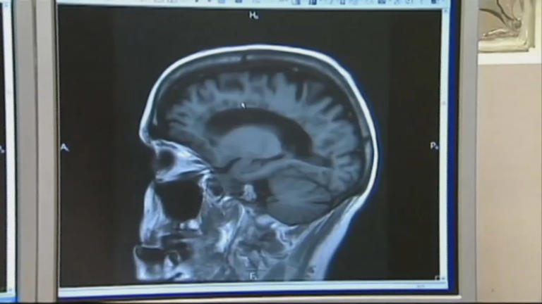 Aiming to make the game safer, new BU study shines light on CTE in football