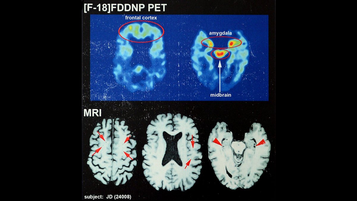 Aiming to make the game safer, new BU study shines light on CTE in football
