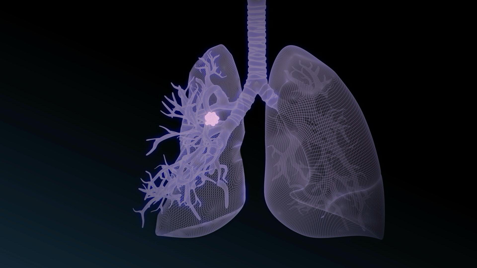Animation : Le nodule pulmonaire