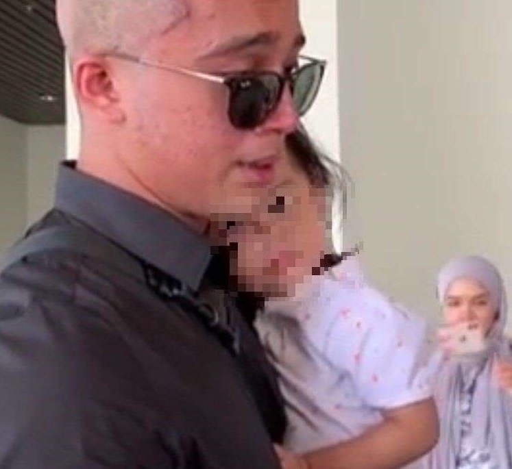 Red Marks On Scalp Not Scabies But Effects Of Hair Transplant