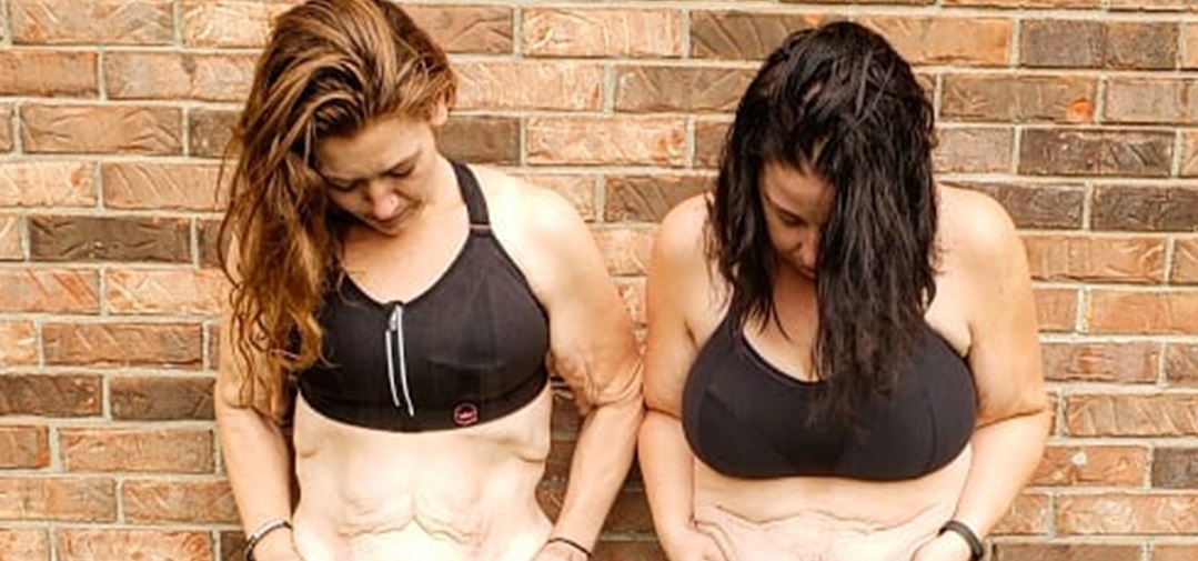 After Extreme Weight Loss 2 Women Share Painful Challenge