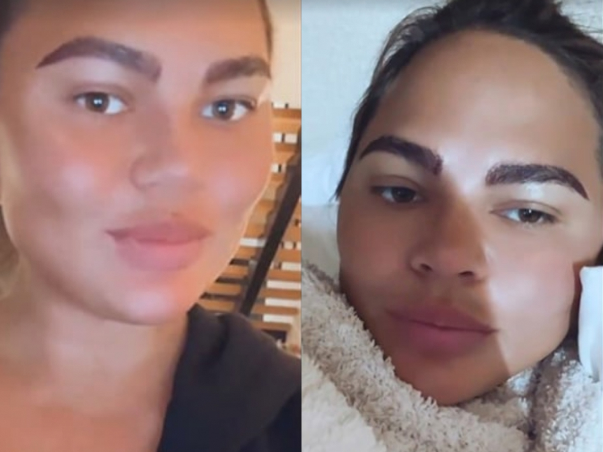 <p><a href="https://www.wonderwall.com/celebrity/profiles/overview/chrissy-teigen-1561.article">Chrissy Teigen</a> showed off the results of her eyebrow hair transplant on Instagram in November 2021. "A little dark form the pencil but it's so cool to have brows again! teens: do not pluck them all off like I did!!" she captioned one selfie she posted on her Instagram Story, adding on another (right), "This is right after surgery!! crazy!!" Of course, this isn't the only plastic surgery procedure Chrissy has undergone...</p>