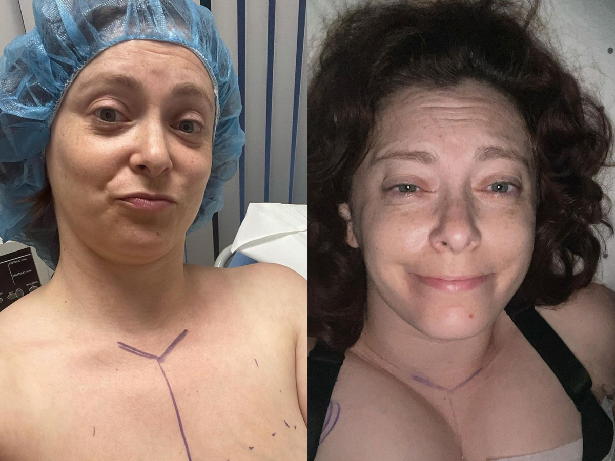 <p>In August 2021, Rachel Bloom finally underwent the breast reduction surgery she'd been longing for and shared the news with fans on Instagram with these before-and-after <a href="https://www.instagram.com/p/CSf_Tq0LSiE/">photos</a> she captioned simply, "I did it!"</p>