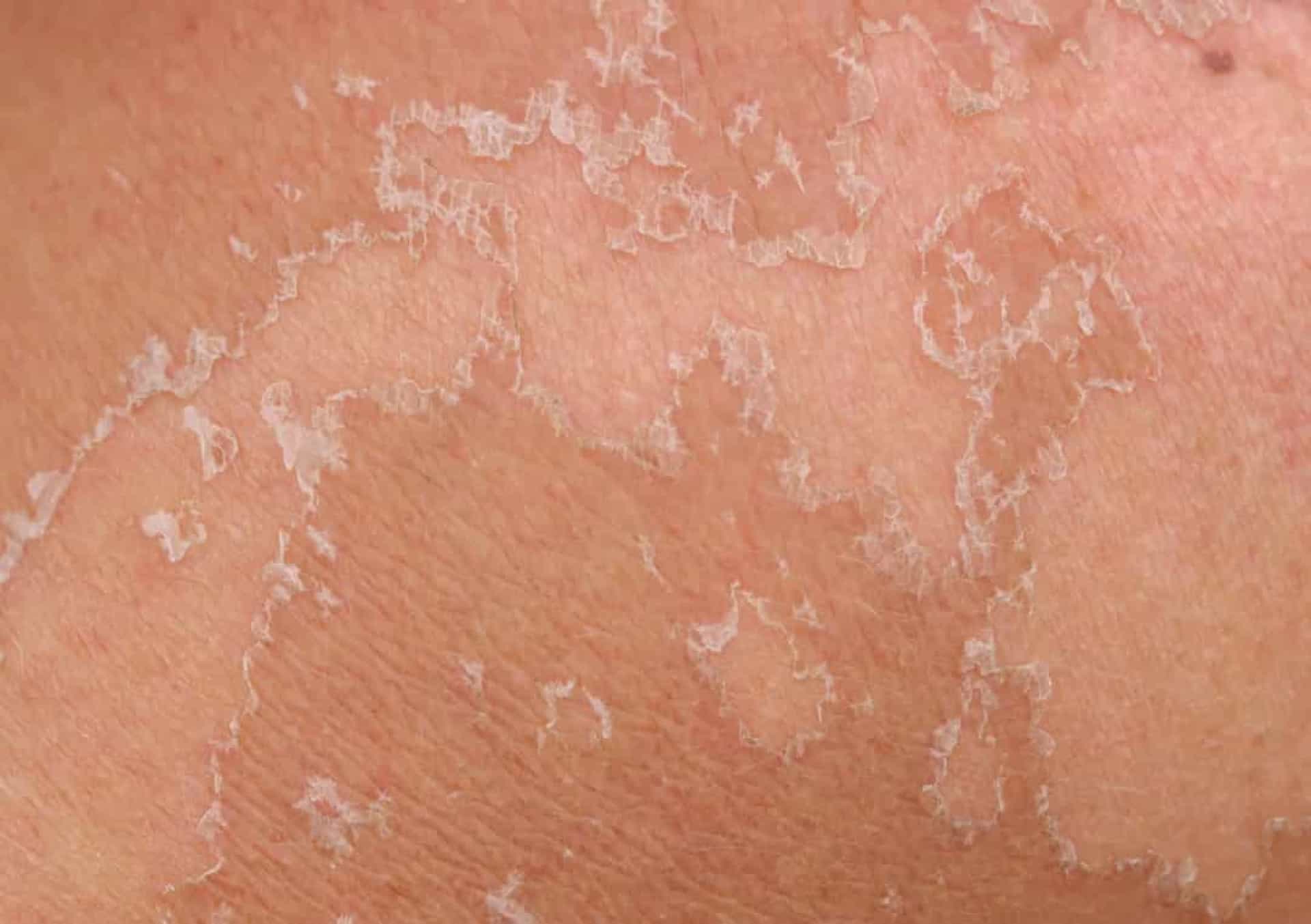 This is what happens if you don't wash yourself