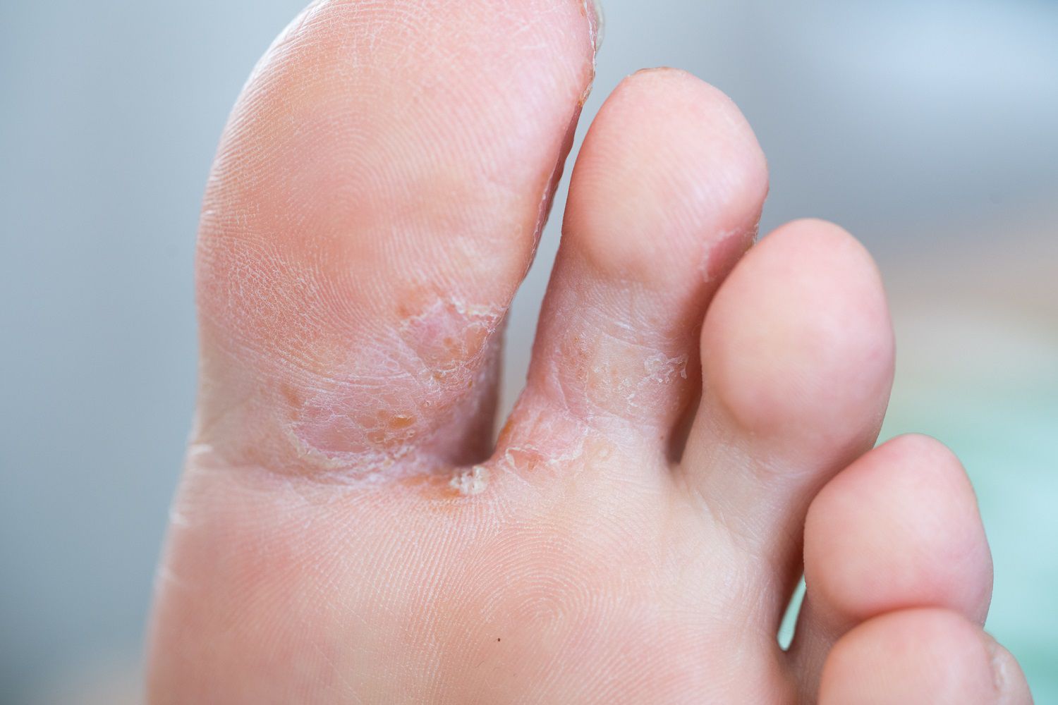 remedio casero para eliminar los hongos de las uñas de los pies