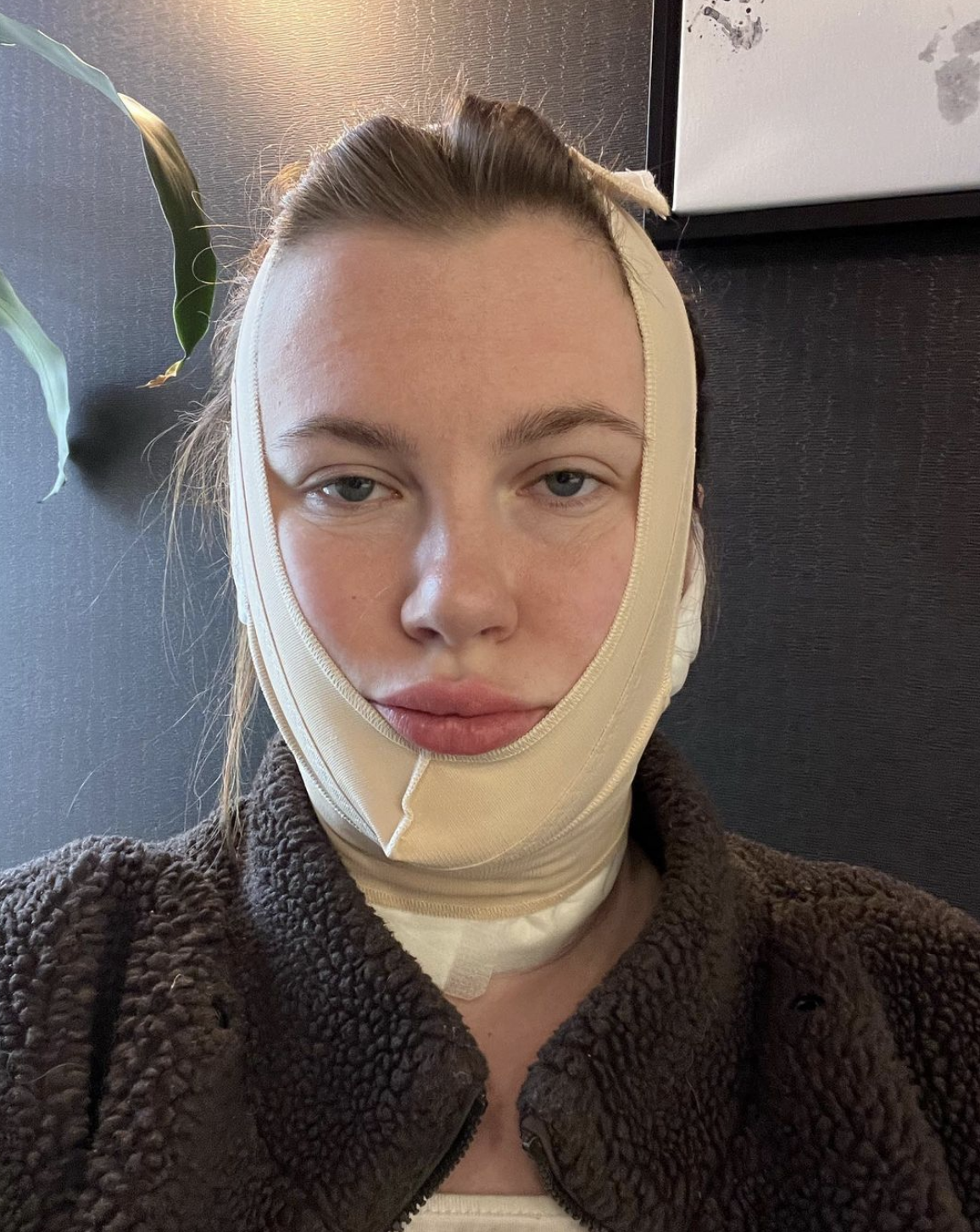 <p>Ireland Baldwin posted this photo of herself in a pressure bandage after undergoing a FaceTite procedure on her neck and chin on April 9, 2022. She explained in a TokTok <a href="https://www.instagram.com/p/CcQikMspFWw/">video</a> a few days later why she did it. She said the "hour-long, in-office procedure" that's "minimally invasive" didn't require anesthesia. "You don't go under the knife. Nothing like that. The reason I had it done is because I had this very stubborn pocket of fat and extra skin [on] my face," she explained. "As I've gained weight and as I've aged, it hasn't gone away at all. It's only become worse and worse." According to Ireland, diet and exercise didn't help the "pocket of fat" she disliked. She defended herself against criticisms that she's too young to have the procedure. "I'm 26. I'm not underage. I'm a consenting adult who made this choice and I couldn't be happier," she said. Ireland also said she's had "no other modifications done to my body or my face."</p>