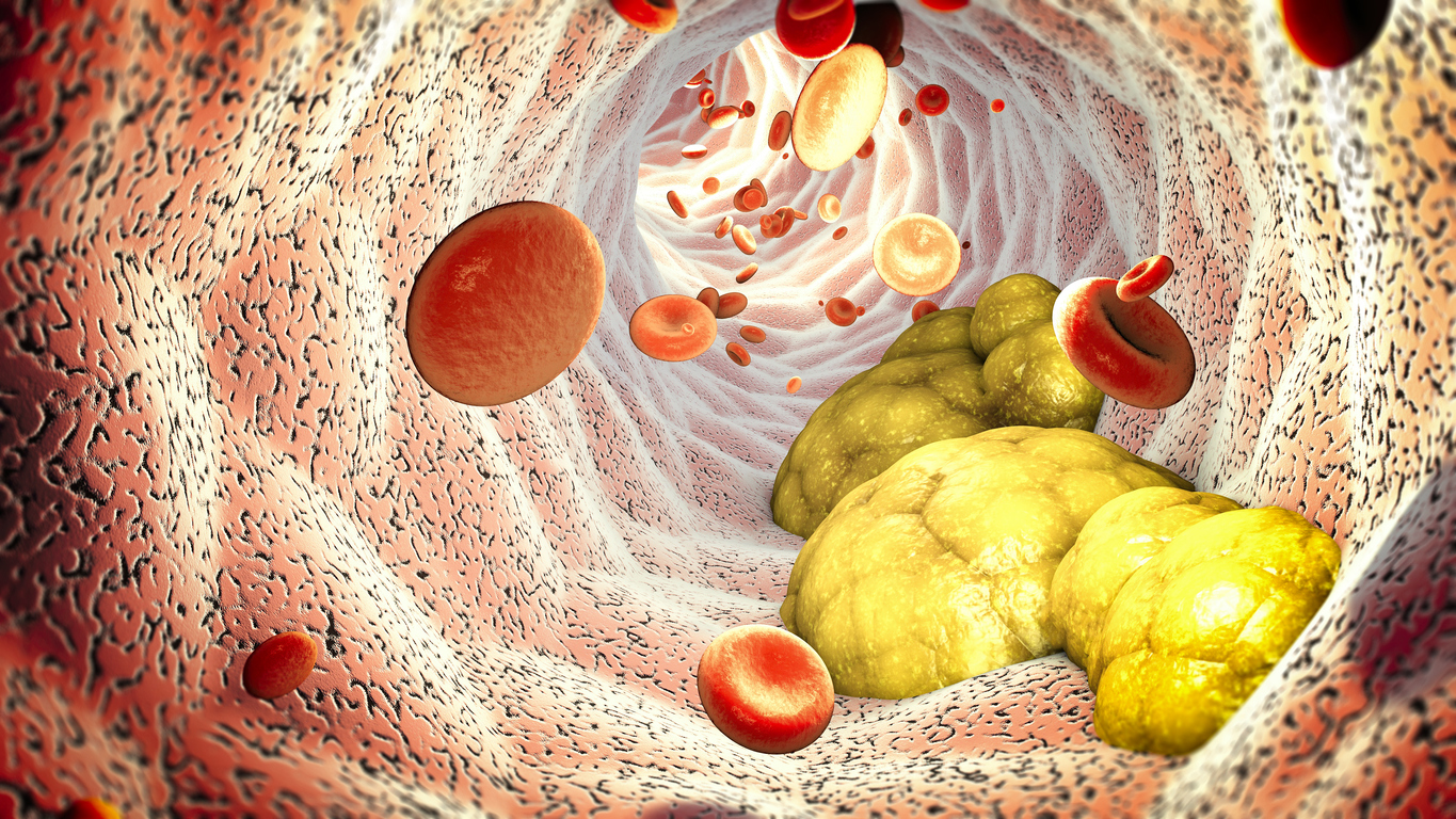 conheça os sintomas de colesterol alto e 4 formas de controlá-lo