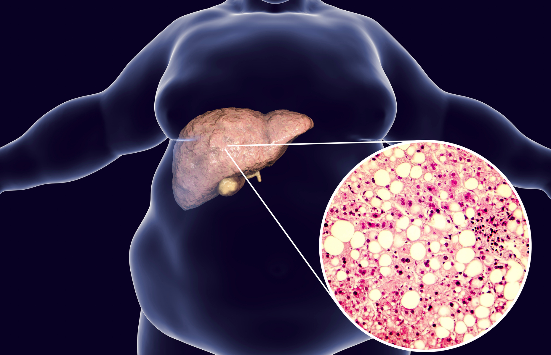 fatty-liver-disease-what-you-need-to-know