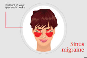 sinus migraine