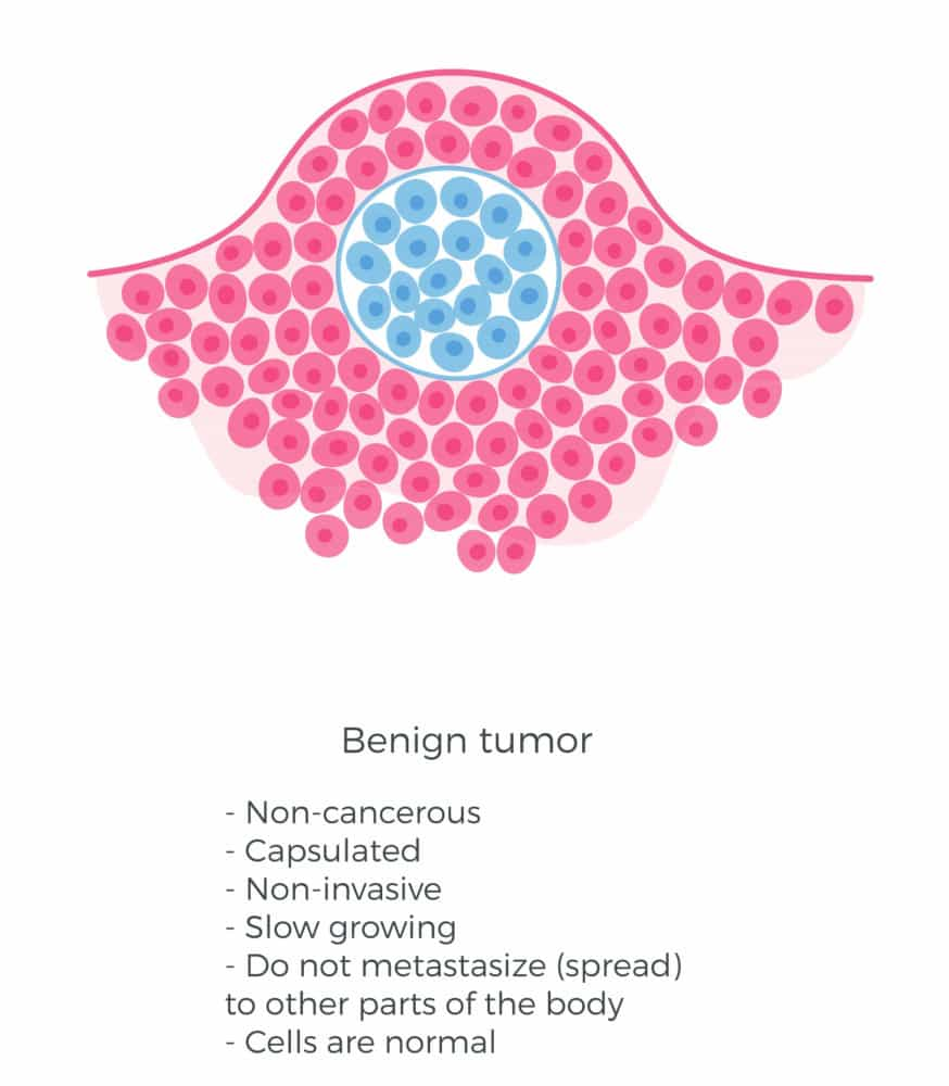 What do we know about tuberous sclerosis?