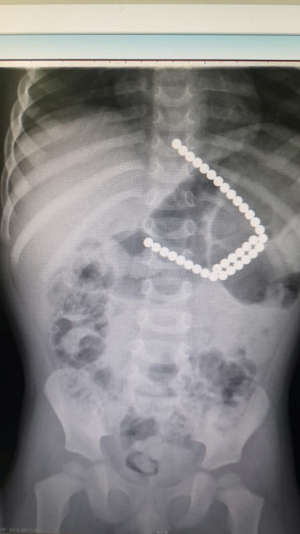 תצלום רנטגן של מגנטים בקיבה. עלולים לגרום לחסימת מעי