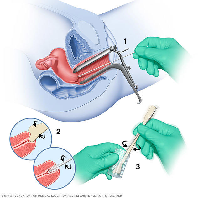 pap-smear