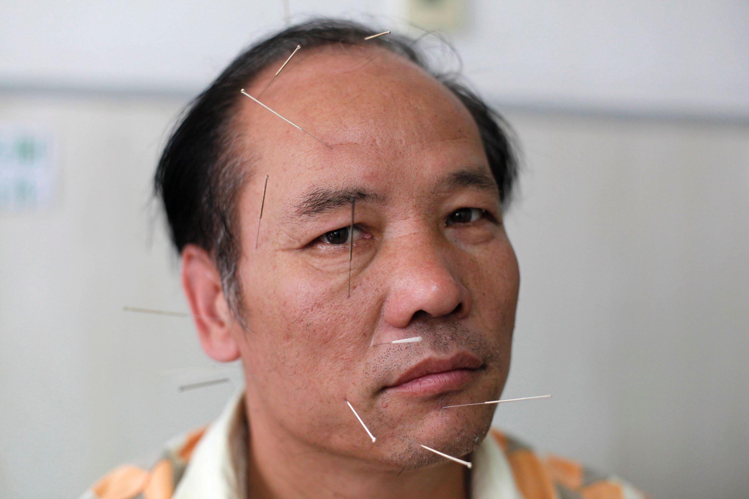 Slide 8 of 15: Moebius Syndrome