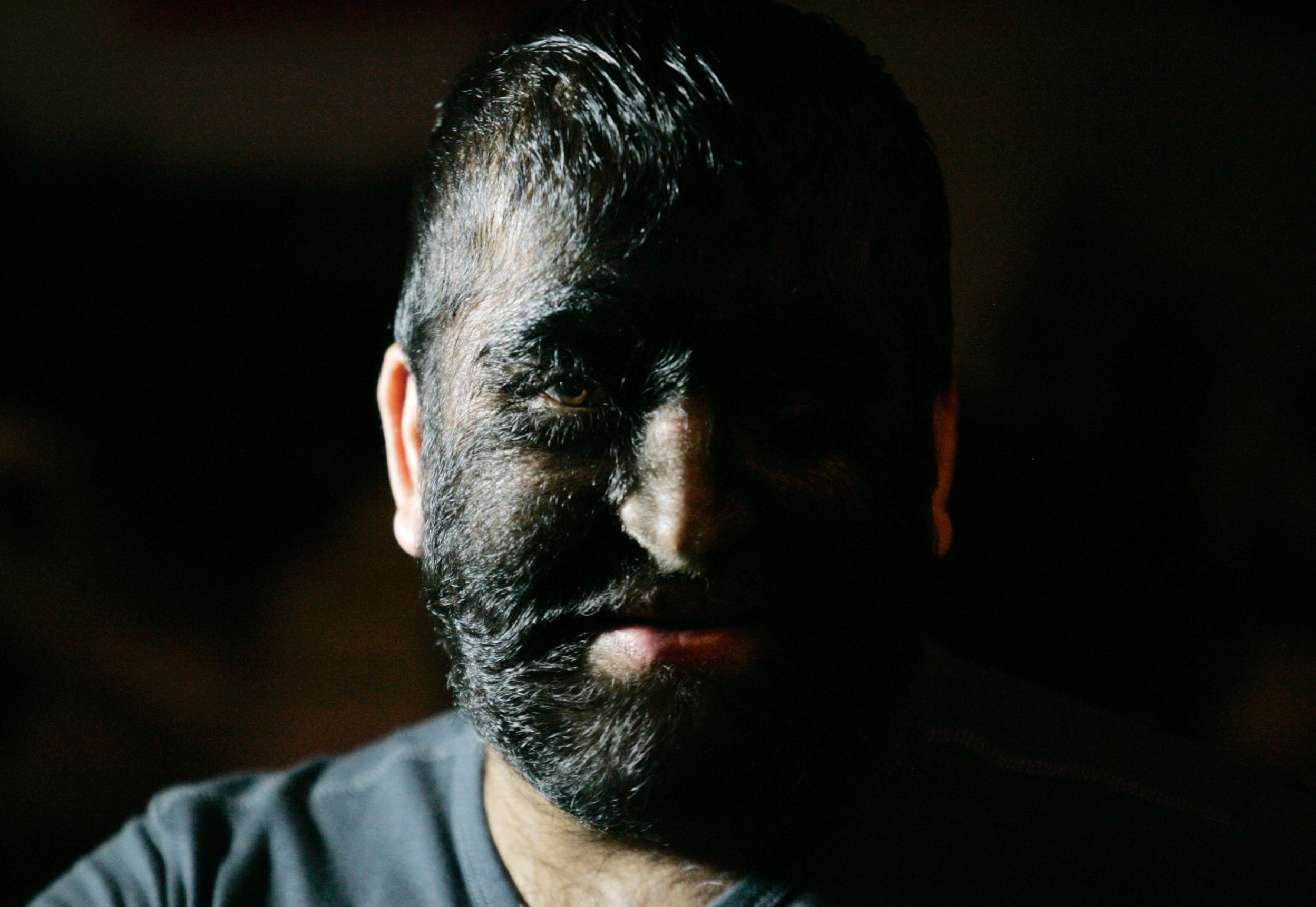 Slide 7 of 15: Werewolf Syndrome