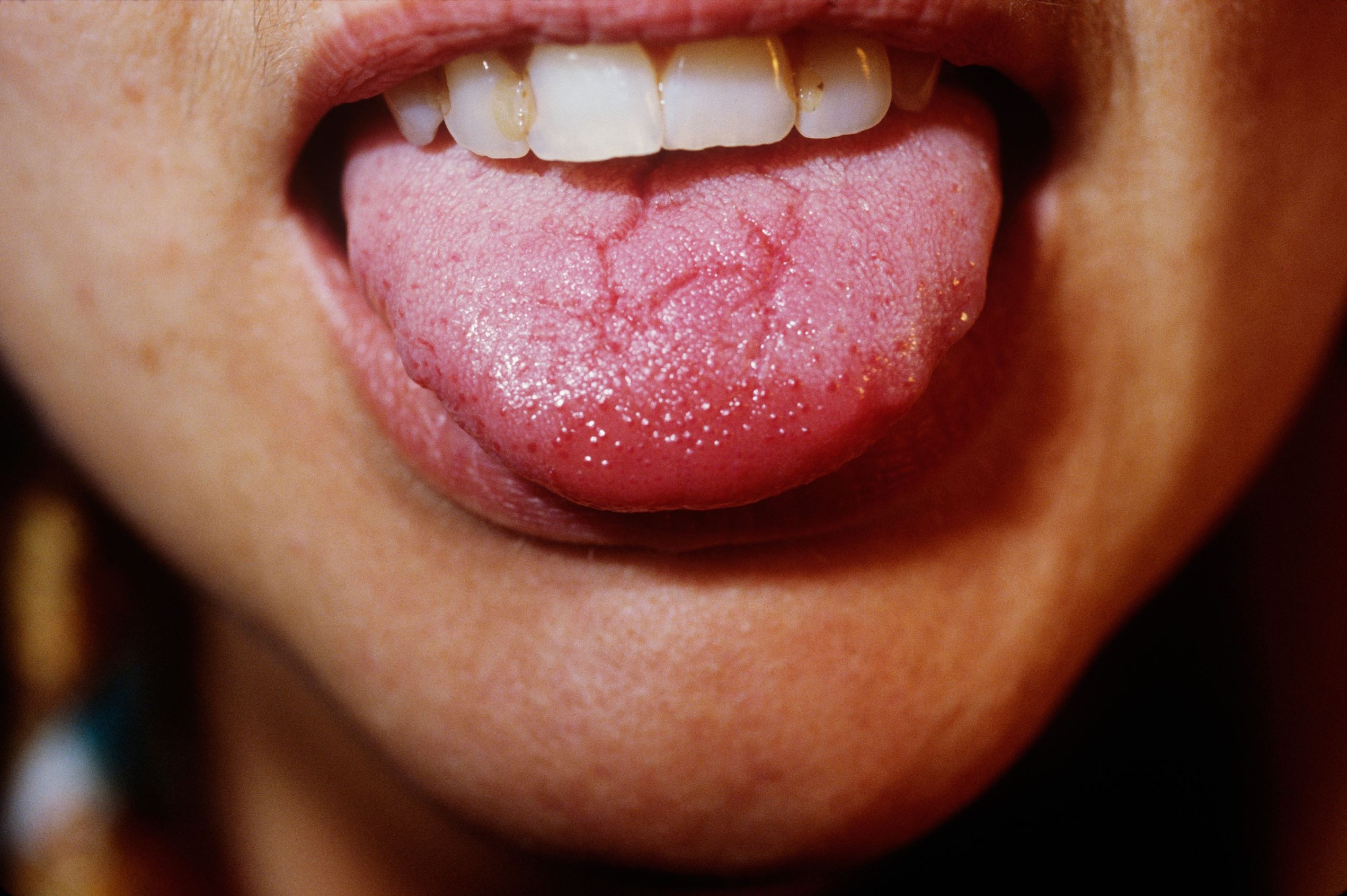 ÎÎ¹Î±ÏÎ¬Î½ÎµÎ¹Î± 9 Î±ÏÏ 15: Geographic Tongue Syndrome