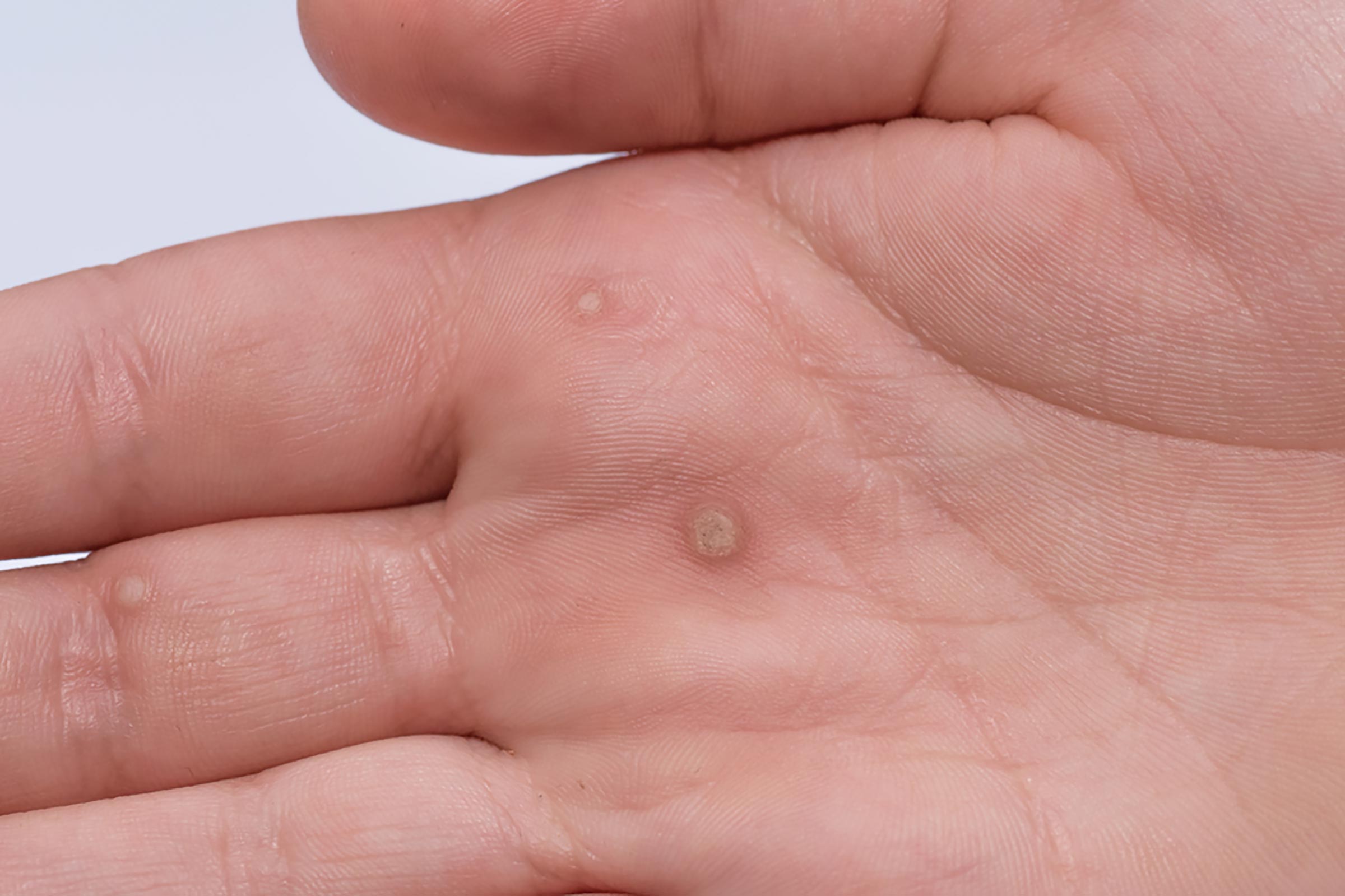 Boils Cysts Ingrown Hairs And 11 Other Skin Mysteries Explained