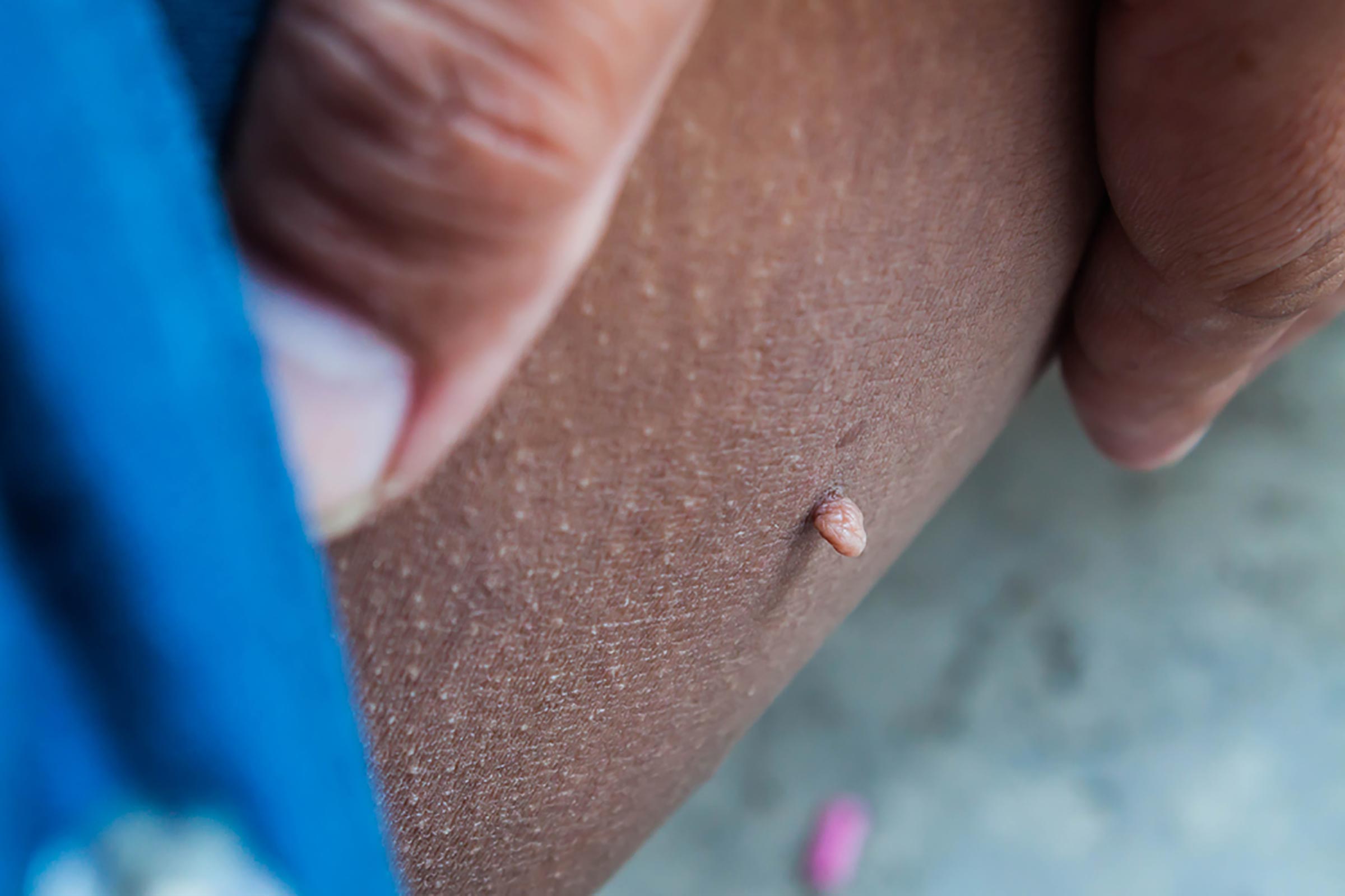 Boils Cysts Ingrown Hairs And 11 Other Skin Mysteries Explained