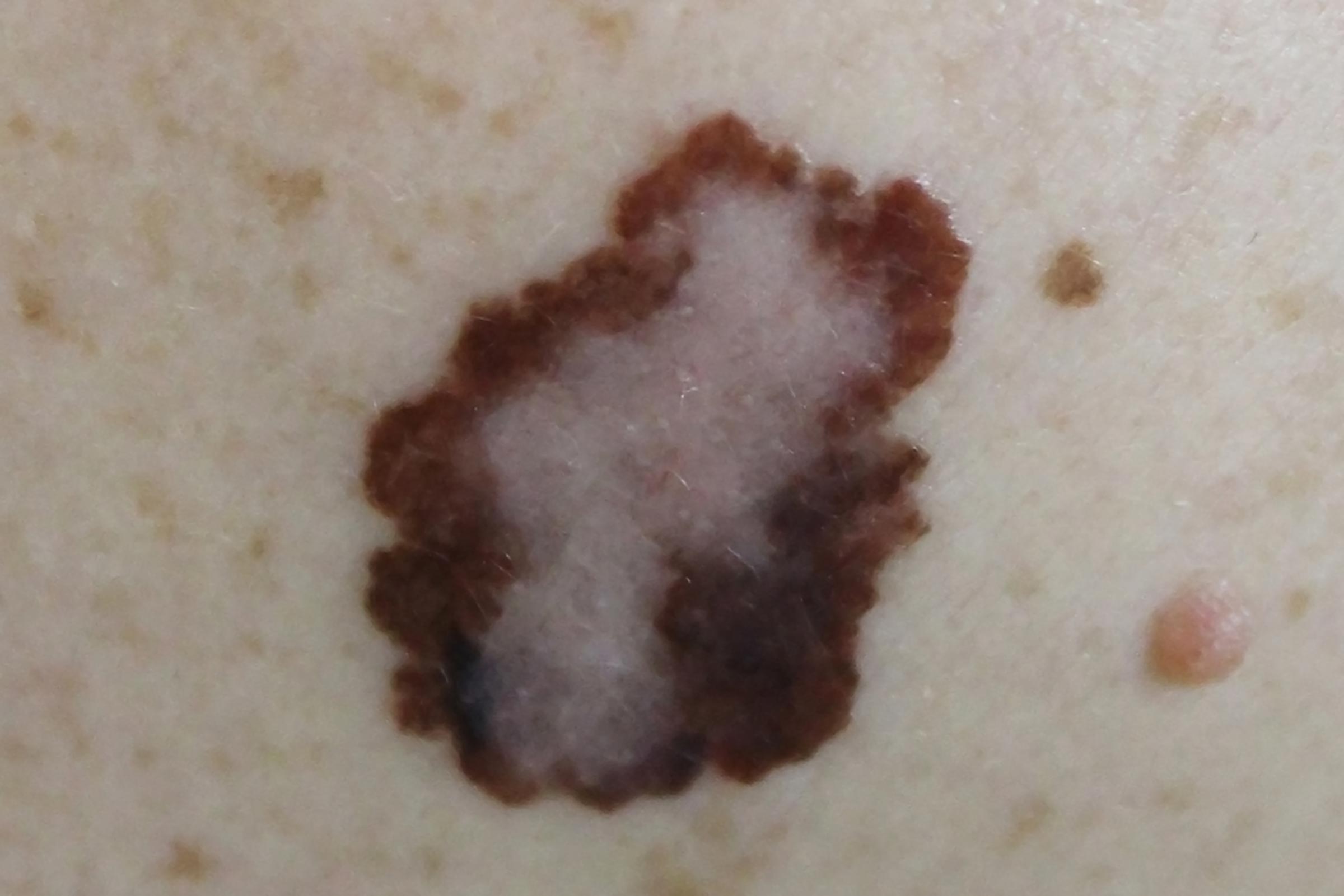 Boils Cysts Ingrown Hairs And 11 Other Skin Mysteries Explained