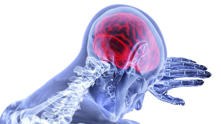 saran pakar untuk cegah kerusakan otak akibat pembengkakan pembuluh darah yang tersumbat