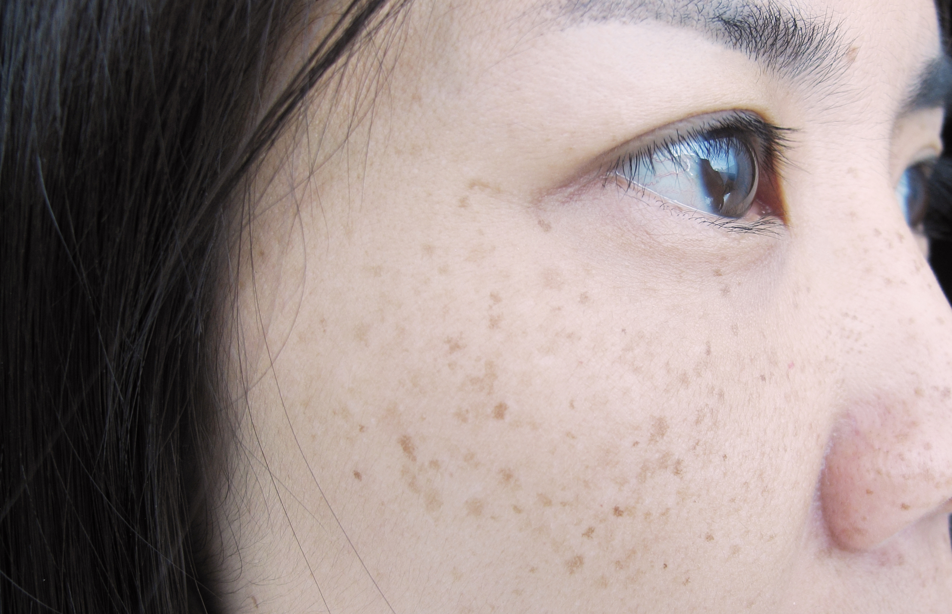 Freckles, moles and skintags: What they say about your health